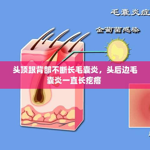 頭頂跟背部不斷長(zhǎng)毛囊炎，頭后邊毛囊炎一直長(zhǎng)疙瘩 