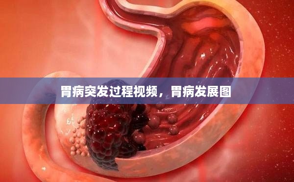 胃病突發(fā)過(guò)程視頻，胃病發(fā)展圖 